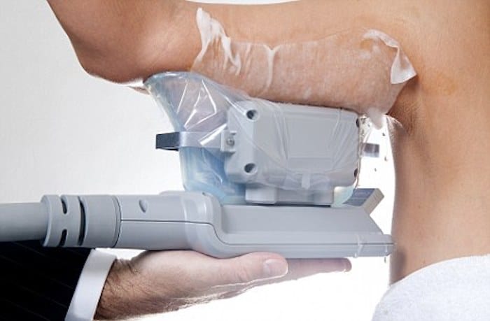 fat freezing arms Swinton