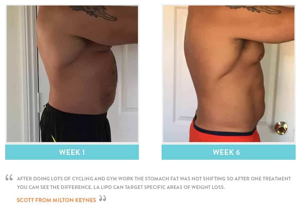 Before & After Stomach Fat Swinton
