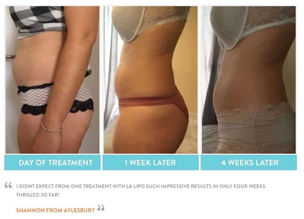 before, Cryolipolysis Swinton