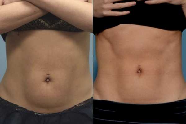 body sculpting FAQs Swinton