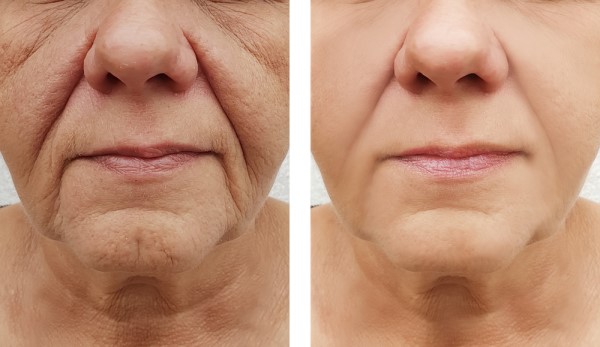 Learn more about Morpheus8 Treatment Swinton today!