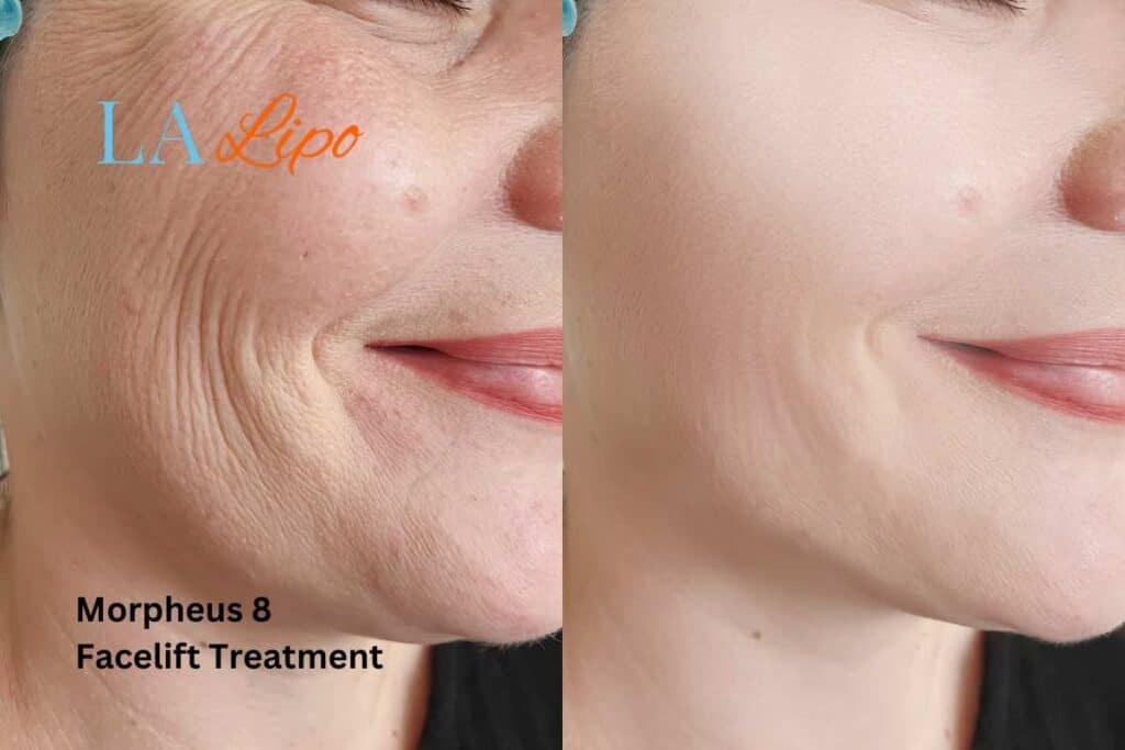 Morpheus8 Treatment Swinton for flawless skin! Call us today!