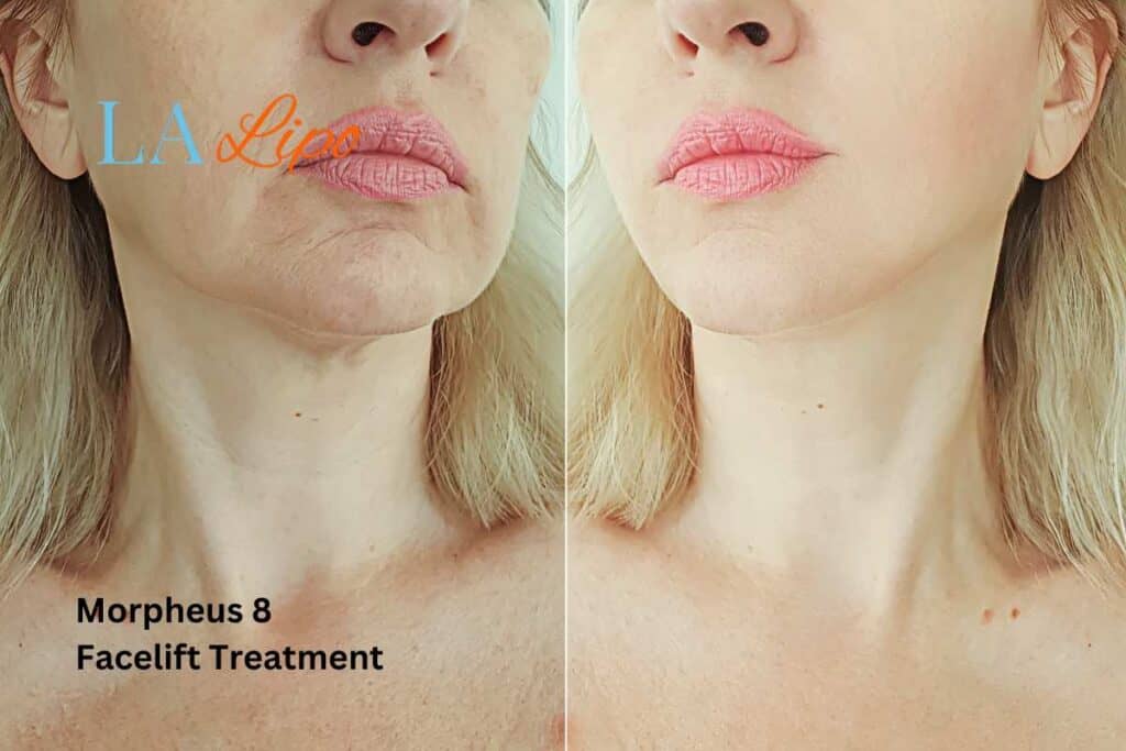 Turn back time with Morpheus8 Treatment Swinton