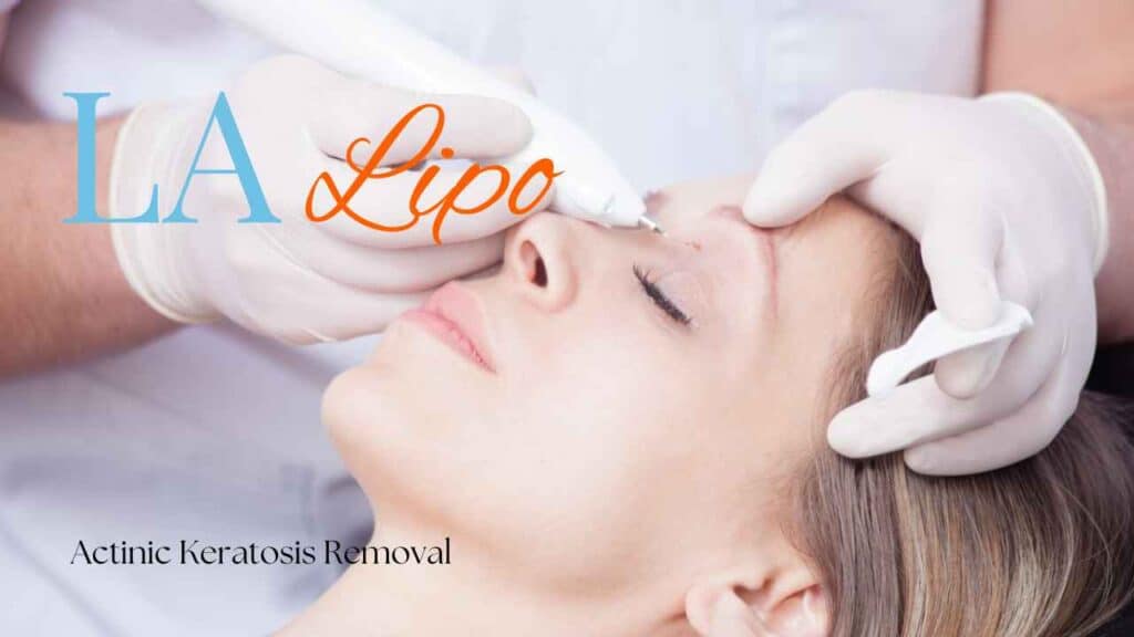 actinic keratosis removal Swinton