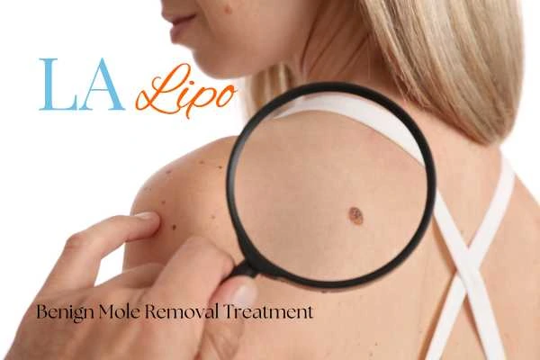 Why getting moles removed Swinton can boost your confidence!
