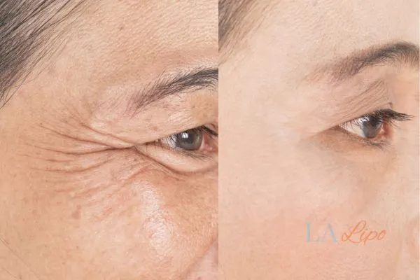 Before and after results of woman - HI-fu wrinkles reduction treatment Swinton
