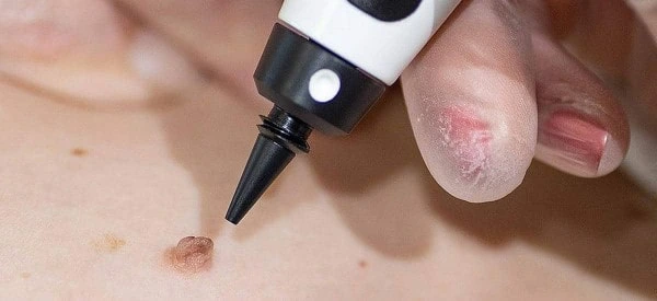 skin tag removal using cryopen Swinton