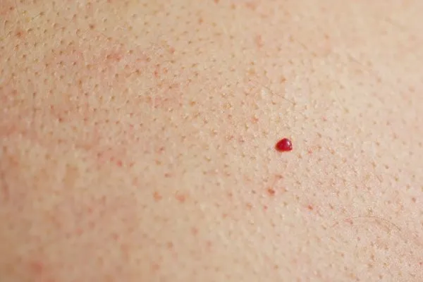 close up of a cherry angioma Swinton