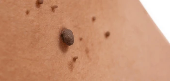 image of a skin tag Swinton
