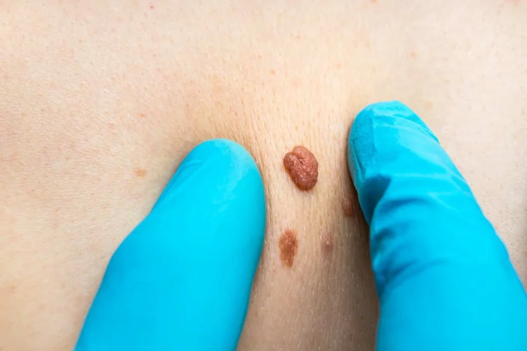 Consultant examining a skin tag Swinton