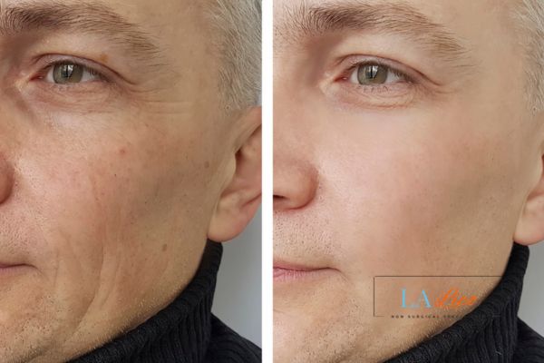 See the amazing results of Morpheus8 Treatment Swinton!