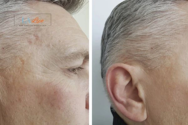 Mens Before & After Morpheus 8 Results Swinton