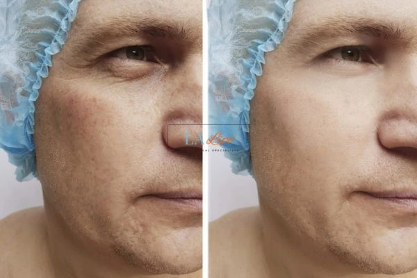 Before and after Morpheus 8 Results Swinton