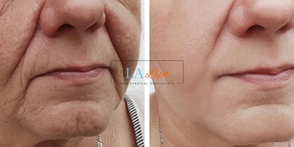 Older lady deeper wrinkle reduction - LA LIPO Morpheus 8 Results Swinton