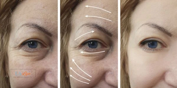 Amazing eye lift Morpheus 8 results Swinton